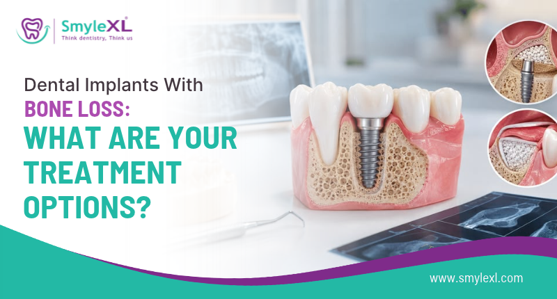 Dental Implants With Bone Loss: What Are Your Treatment Options