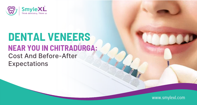 Dental Veneers Near You in Chitradurga: Cost and Before-After Expectations