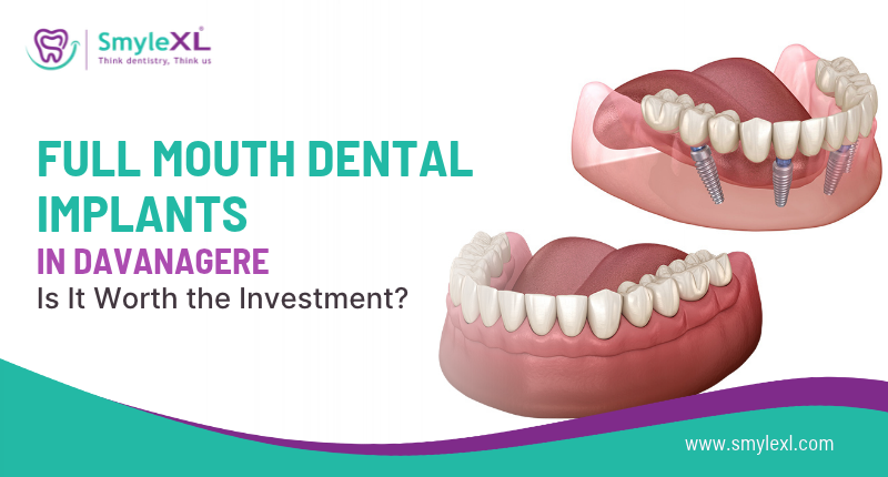 Full Mouth Dental Implants in Davanagere: Is It Worth the Investment?