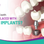 How Many Teeth Can Be Replaced With Dental Implants?
