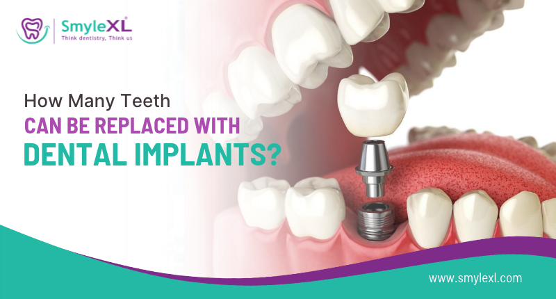 How Many Teeth Can Be Replaced With Dental Implants?