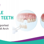 Multiple Missing Teeth in Rahuri: Implant-Supported Bridge vs Full Arch