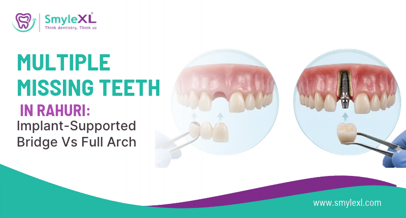 Multiple Missing Teeth in Rahuri: Implant-Supported Bridge vs Full Arch
