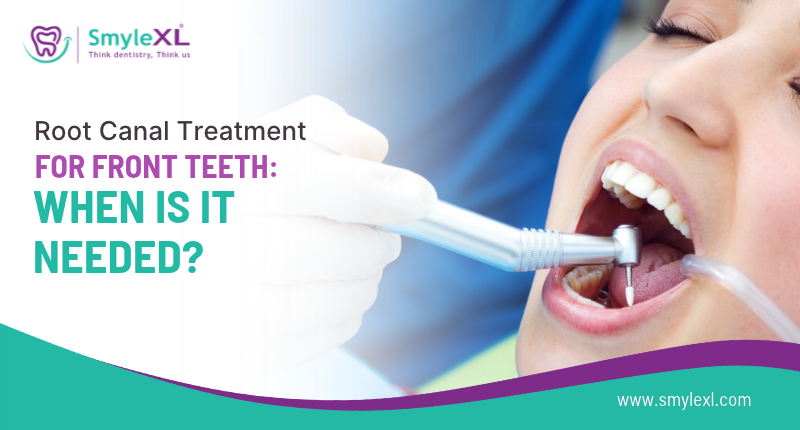 Root Canal Treatment for Front Teeth: When Is It Needed?
