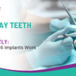 Same-Day Teeth Fixed Permanently: How All-on-6 Implants Work