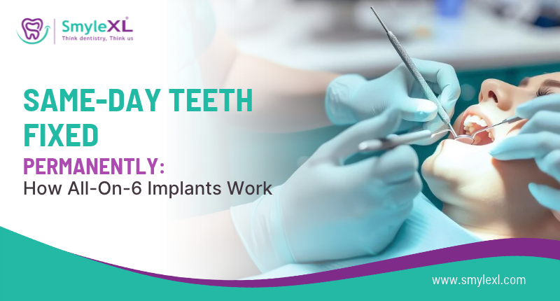 Same-Day Teeth Fixed Permanently: How All-on-6 Implants Work