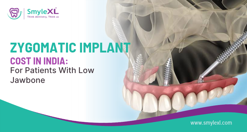 Zygomatic Implant Cost in India: For Patients With Low Jawbone